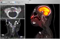 Oblique MPR with PET-CT Fusion