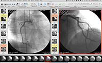 Angiograms