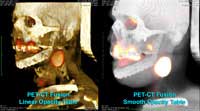 Real PET-CT fusion in Volume Rendering with different opacity tables