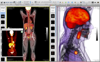 PET-CT