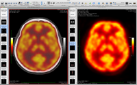 PET-CT